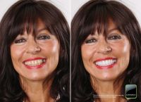 Glamsmile Porselein