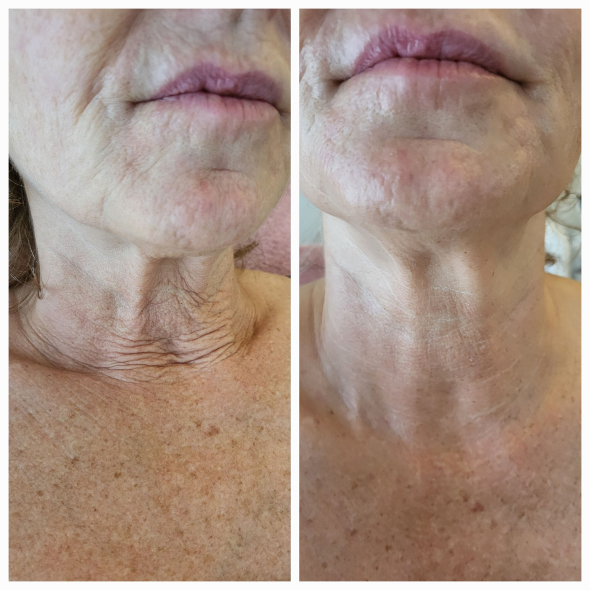 Y-zone Mesotherapie